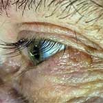 bultjes-rondom-oog-voor-behandeling-coaguleren